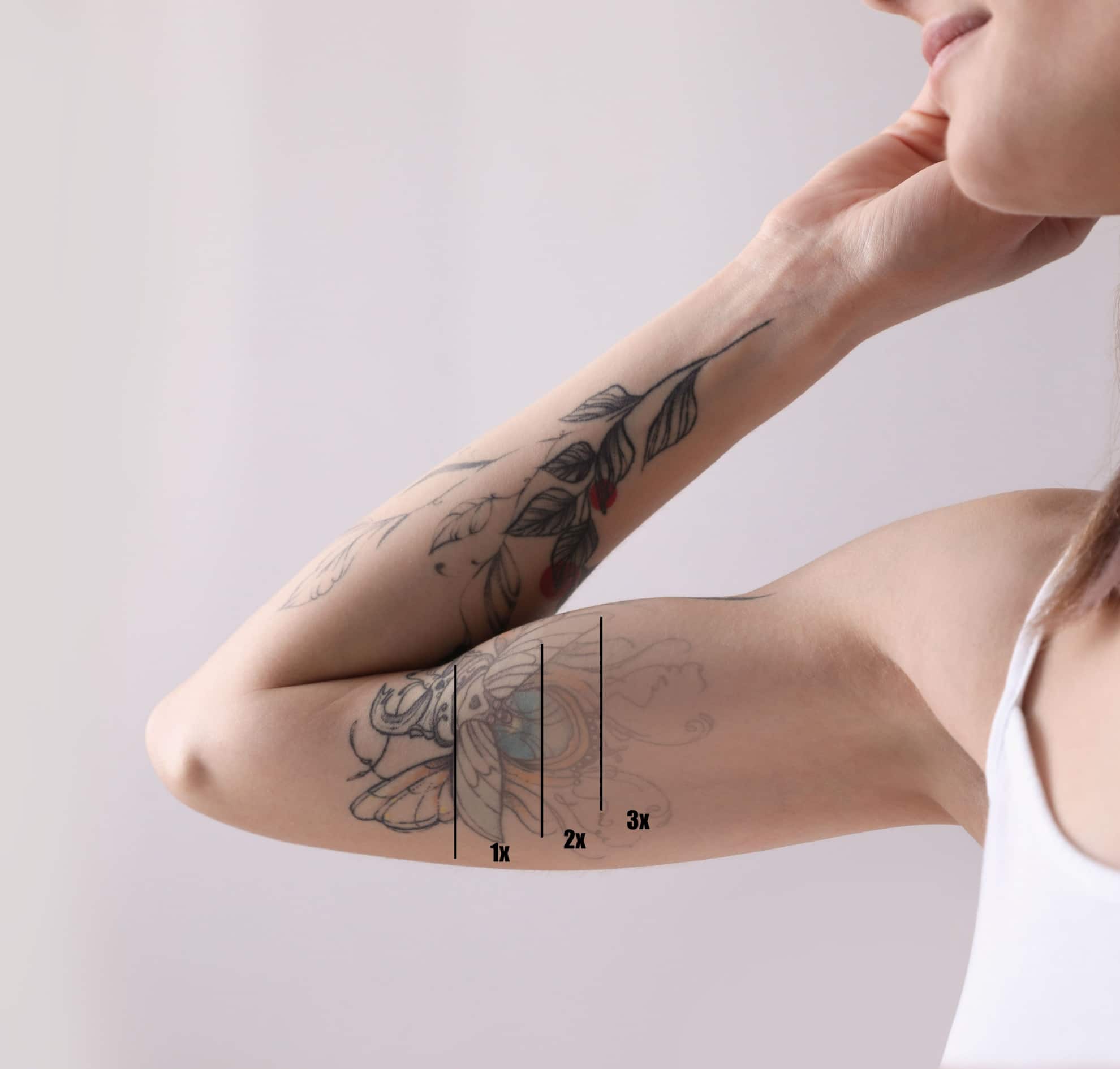 Détatouage – Laser Picoseconde