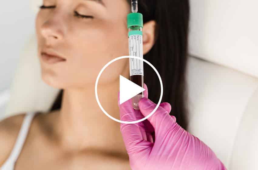 Lifting vampiro o PRP (plasma ricco di piastrine)