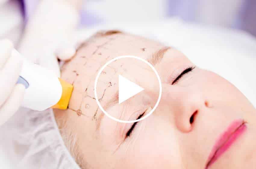 Thermage facelift