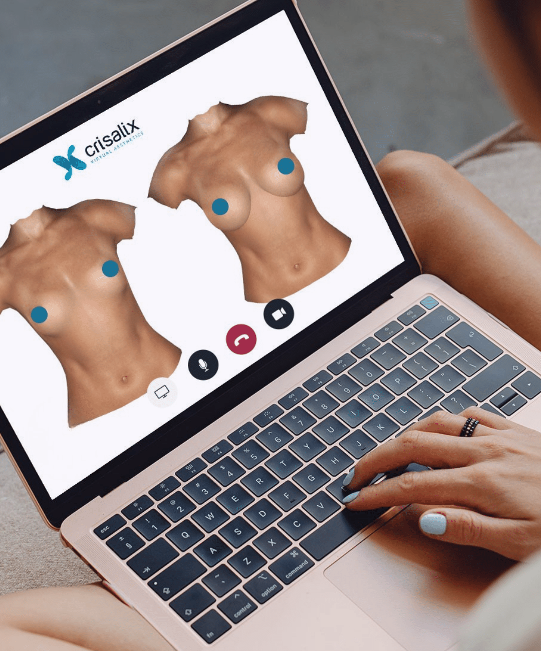Crisalix: visualizzare un progetto di chirurgia estetica per migliorare la comprensione e il processo decisionale